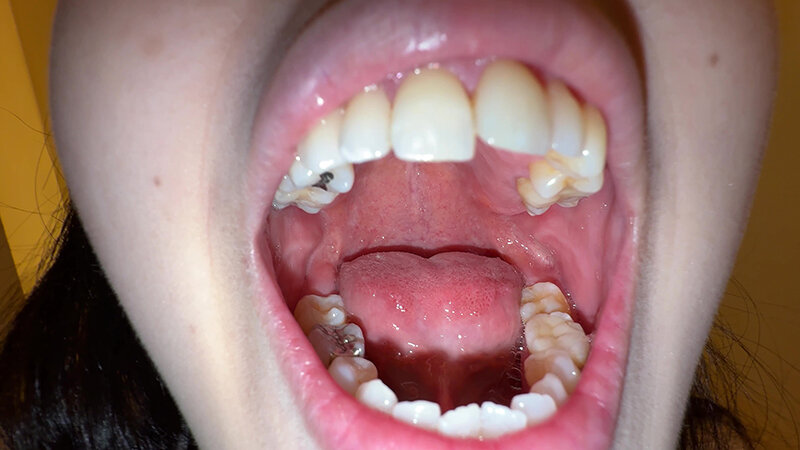 【個人撮影】横山夏希の喉チンコ触り&肉厚舌を開口器で観察 1枚目