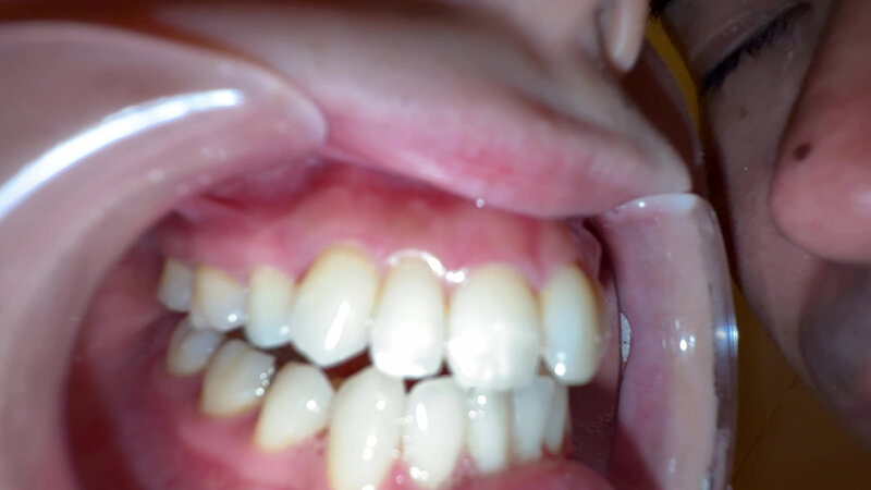 【個人撮影】横山夏希の喉チンコ触り&肉厚舌を開口器で観察 19枚目