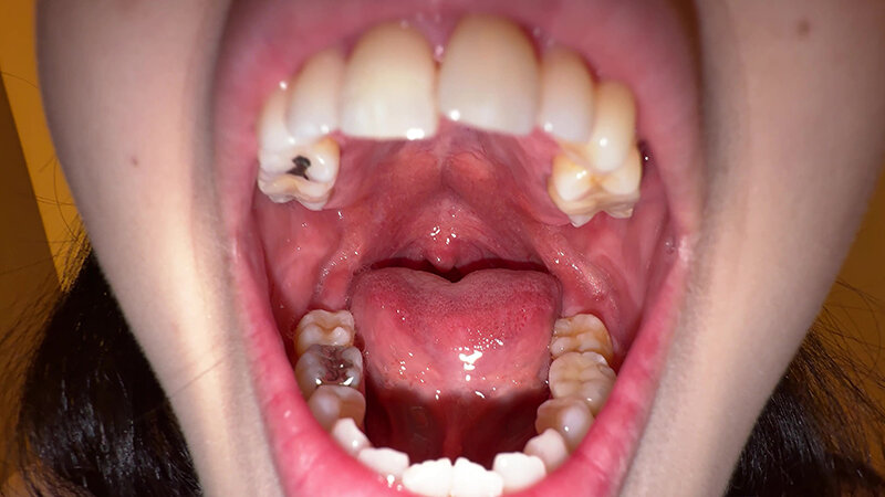 【個人撮影】横山夏希の喉チンコ触り&肉厚舌を開口器で観察 2枚目